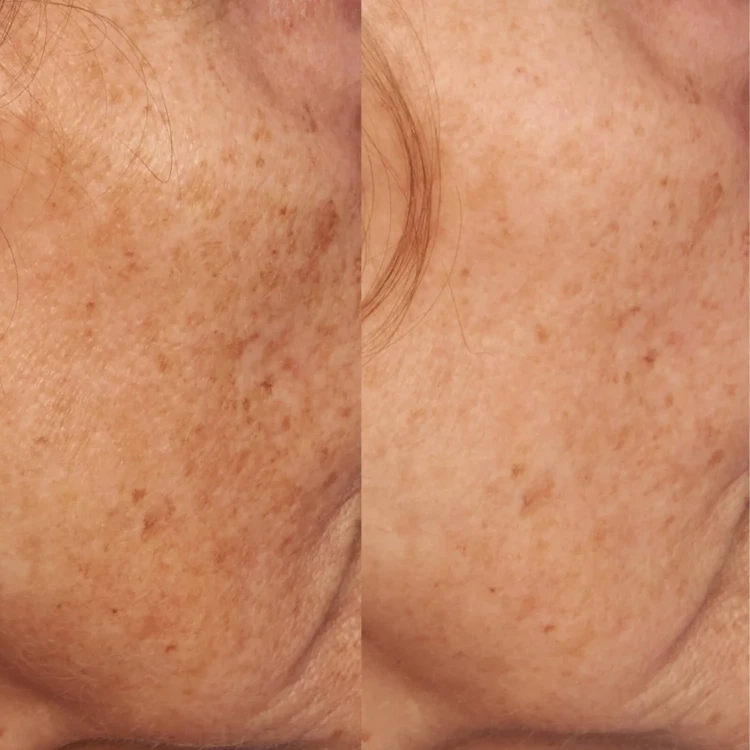Perricone MD Висвітлюючийзасіб з вітаміном С VITAMIN C ESTER INTENSIVE DARK SPOT TREATMENT 30 мл Perricone MD Висвітлюючийзасіб з вітаміном С VITAMIN C ESTER INTENSIVE DARK SPOT TREATMENT 30 мл